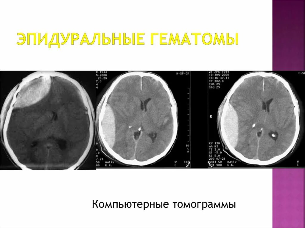Объем гематомы на кт