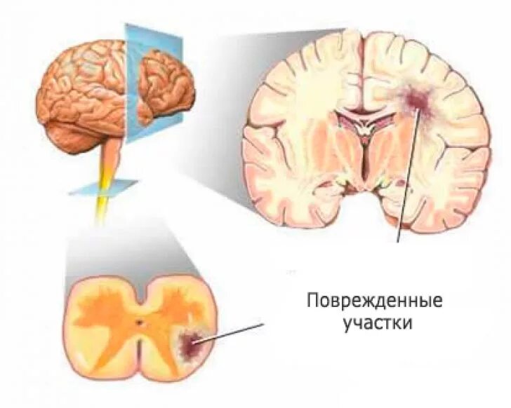 Склероз мозга. Мозг при рассеянном склерозе. Поражение мозга при рассеянном склерозе. Поражение ствола мозга рассеянный склероз. Мозг больного рассеянным склерозом.