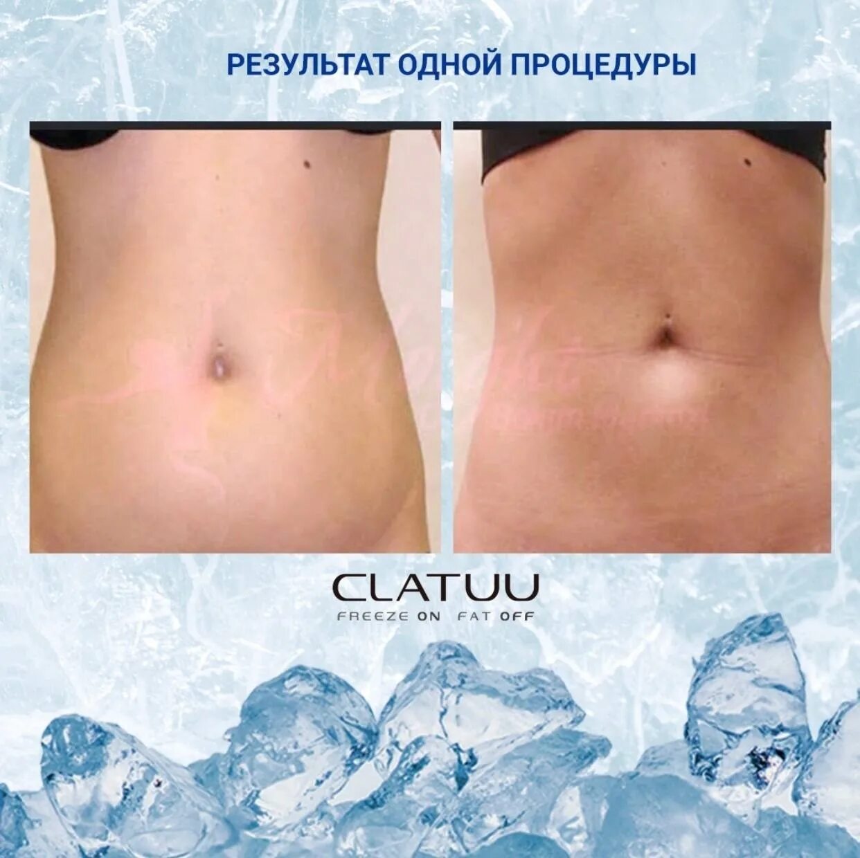 Криолиполиз в самаре. Аппарат криолиполиз s13. Cryolipolysis аппарат криолиполиз. Криолиполиз на аппарате CLATUU.