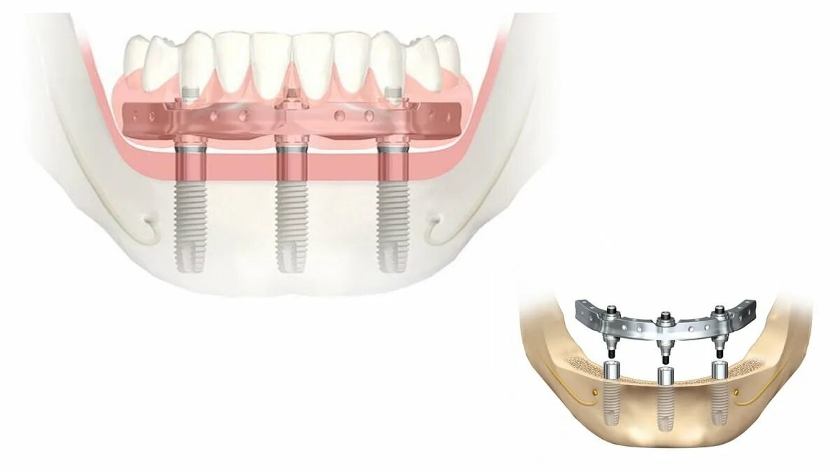 Базальная имплантация biomed. Базальная имплантация челюсти. Базальная имплантация зубов (basal complex). Базальные импланты в стоматологии. Базальная имплантация зубов.