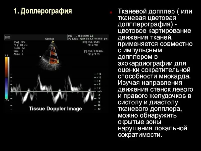 Что определяет доплер. Тканевой импульсно-волновой допплер. Импульсный тканевый допплер это. Тканевая допплерография в эхокардиографии DT 200. Тканевой допплер в клинической эхокардиографии Алехин.