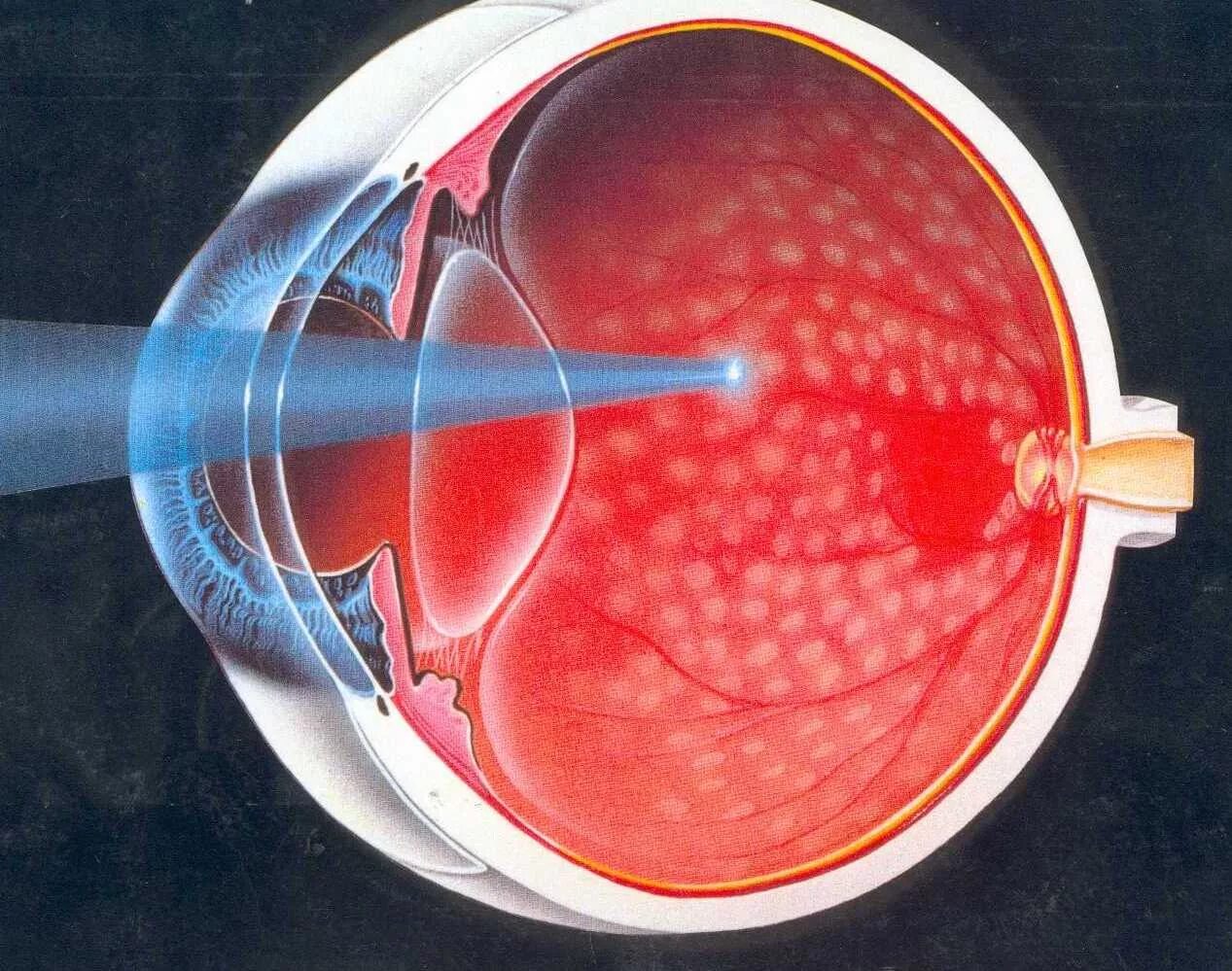 Диабетическая ретинопатия лазерная коагуляция. Лазеркоагуляция сетчатки глаза. Панретинальная лазеркоагуляция сетчатки. Отслойка сетчатки лазеркоагуляция.