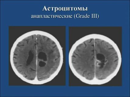Астроцитома grade 3