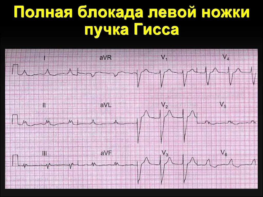 Полная блокада левой ножки пучка Гиса на ЭКГ. Блокада ЛНПГ на ЭКГ. Блокада левой ножки пучка Гиса на ЭКГ. Пленка ЭКГ С блокадой левой ножки пучка Гиса.