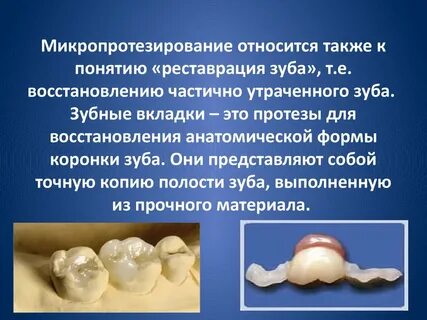 Прямой метод изготовления коронок