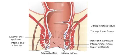 Anal fistula - Coloproctologie