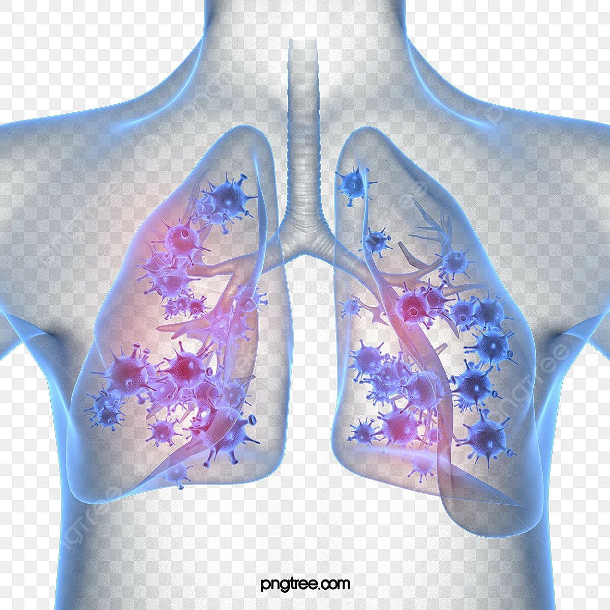 Заражение легких. Заражение легких. Бластомикоз фотографии. Поражение бластомикозом. Бактерии пневмонии.