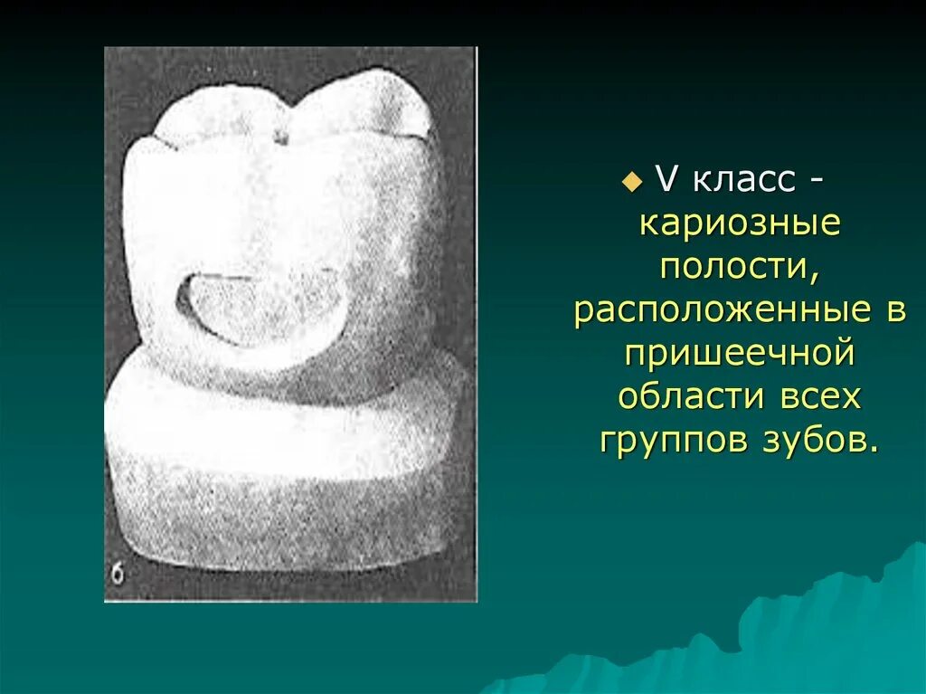 Пломбирование кариозных полостей 5 класса. Препарирование кариозной полости. препарирование и пломбирование полостей v класса. препарирование полостей 5 класса по блэку. формирование кариозной полости по 5 классу блэка.