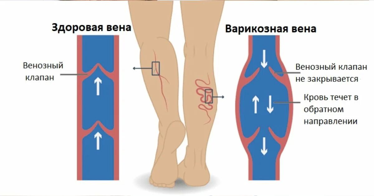 Строение вен нижних конечностей варикоз. Венозное расширение вен нижних конечностей. Варикозные вены нижних конечностей. Профилактика варикозного расширения нижних конечностей