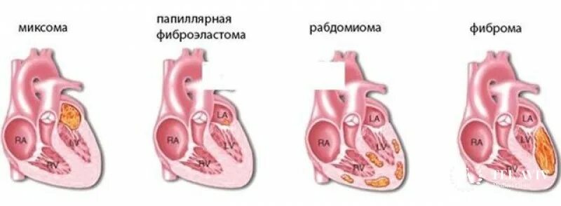 Рабдомиома сердца. Опухоли правого предсердия. Первичные опухоли сердца. Объемные образования сердца.