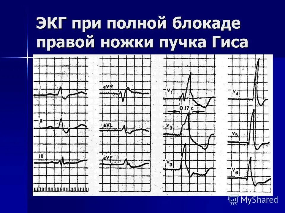 Что означает неполная блокада. Блокада пучка Гиса на ЭКГ. Блокада ножек пучка Гиса на ЭКГ. Блокада правой и левой ножки пучка Гиса на ЭКГ. Блокада правой ножки пучка Гиса на ЭКГ.