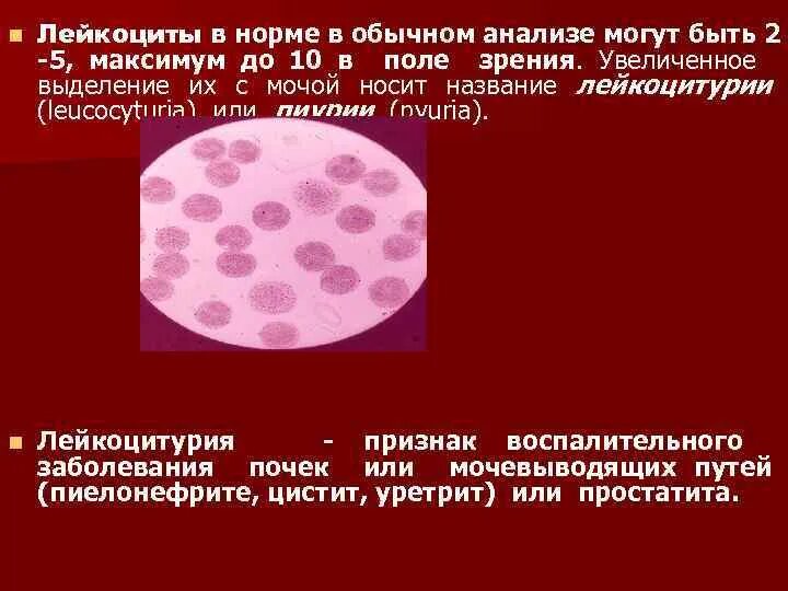 Лейкоциты в моче лейкоцитурия. Нарушение лейкоцитов. Лейкоцитурия. Пиурия лейкоцитов в поле зрения. Выраженная лейкоцитурия.