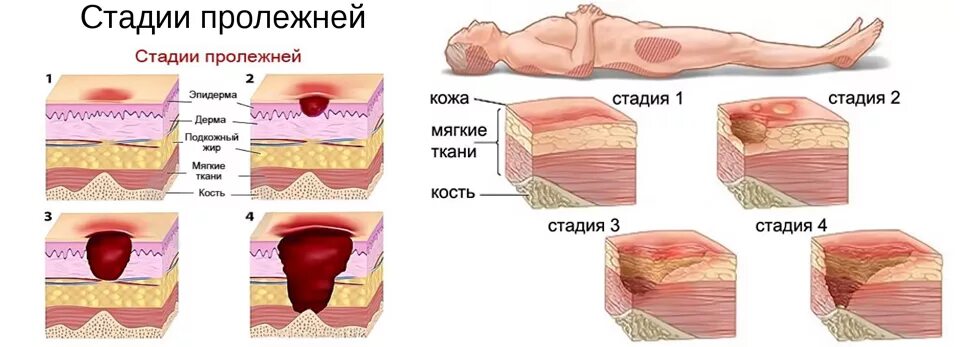 Сколько заживает глубокий. 4 Степени развития пролежней. Стадии пролежней 2 степени. Обработка пролежней 2 стадии.