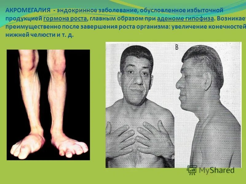 Аденома гипофиза акромегалия. Акромегалия гиперфункция. Болезнь увеличение. Акромегалия пропедевтика внутренних болезней. Гиперфункция гипофиза акромегалия.