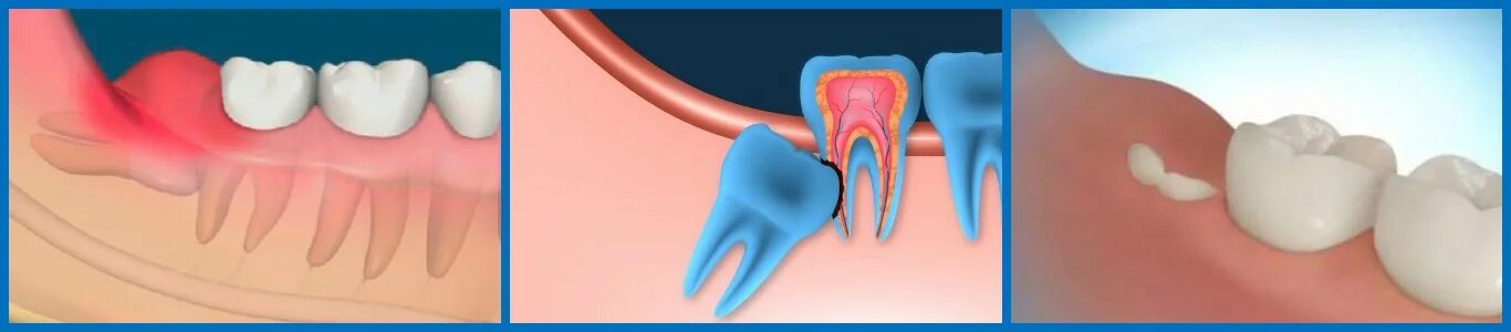 Зуб мудрости почему так назван. Перикоронарит воспаление. Хронический перикоронит. Прорезается зуб мудрости.