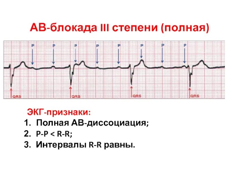 Атриовентрикулярная блокада признаки. Блокада 3 степени ЭКГ признаки. ЭКГ признаки атриовентрикулярной блокады 3 степени являются. ЭКГ критерии АВ блокады 3 степени. Полная АВ блокада на ЭКГ.