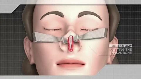 Ринопластика surgery 9mice kai