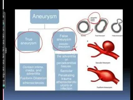 Aneurysm перевод