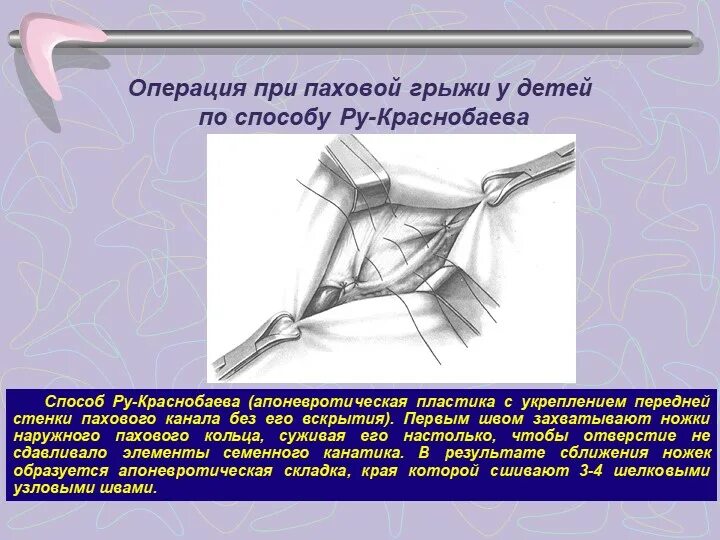 Пластика пахового канала по ру Краснобаеву. Грыжесечение при паховой грыже методы. Ушивание пупочной грыжи методика. Грыжесечение прямой паховой грыжи.