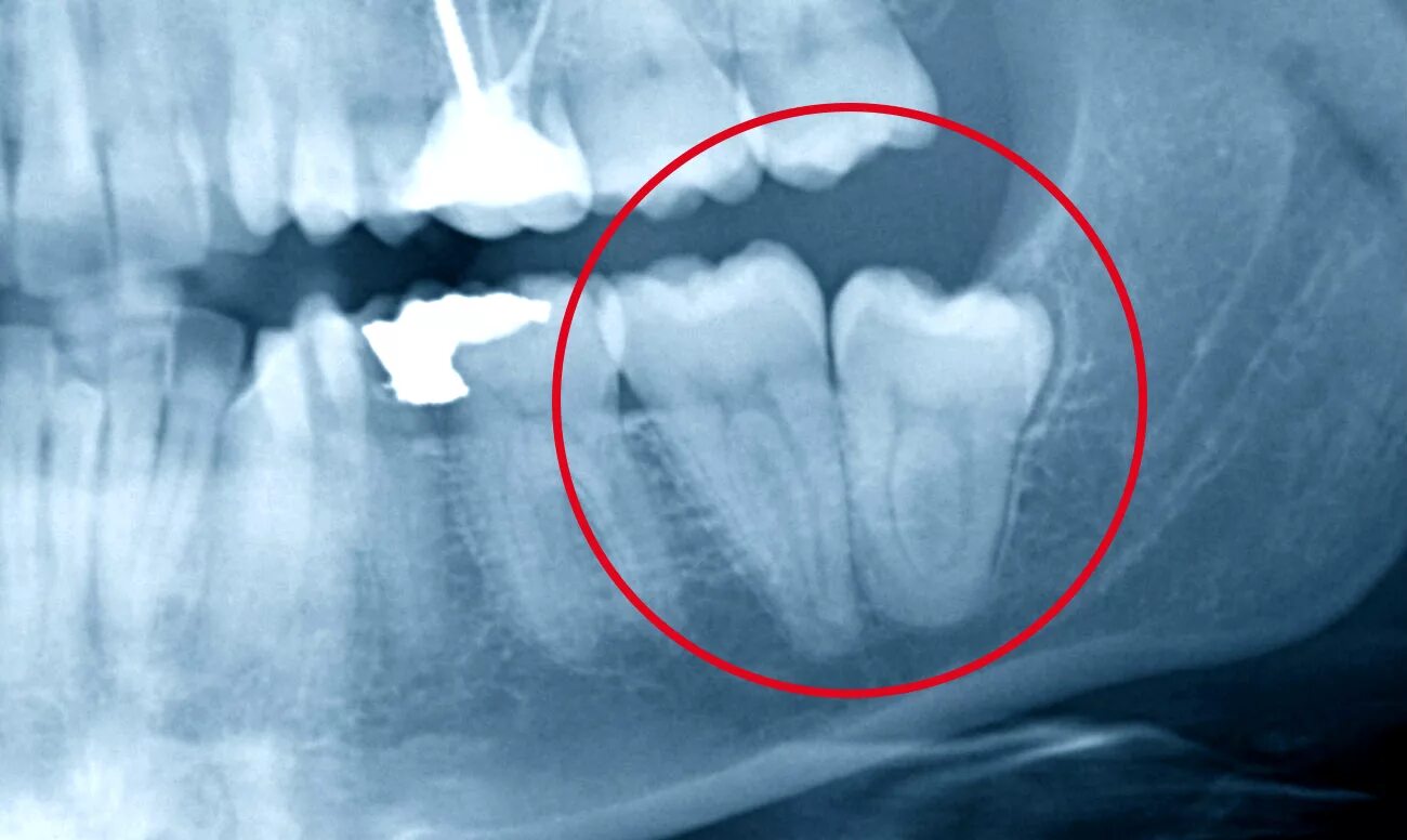 Анкилоз ретинированного зуба. Ретинированный зуб мудрости рентген.