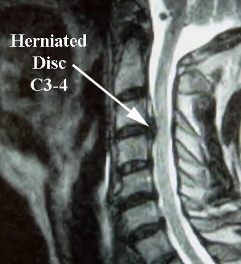 Грыжа 6 мм. Грыжа с4-с5 шейного отдела. Межпозвоночная грыжа шейного отдела с5-с6. S5 и s6 грыжа. С6 шейного отдела грыжа.