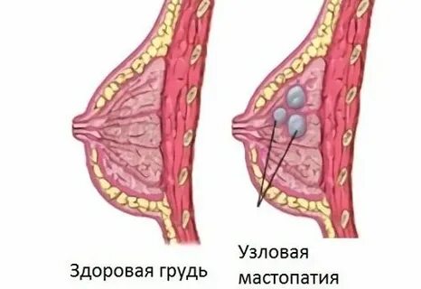 Мастопатия узлы