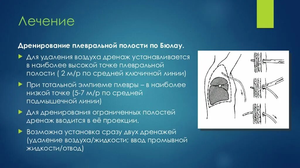 Дренирование гидроторакса. Дренаж по Бюлау при эмпиеме плевры. Дренирование плевральной полости по Бюлау. Через легкие удаляются