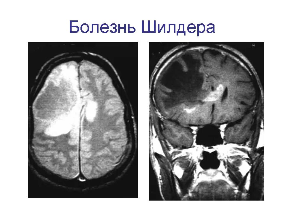 Диффузная церебральная. Диффузный склероз Шильдера на мрт. Лейкоэнцефалит Шильдера мрт. Болезнь Шильдера мрт. Энцефалит Шильдера на мрт.