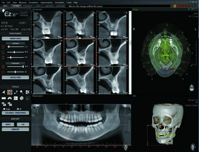 Ez3d Plus панорамный снимок. Программа ez3d Plus. VATECH программа. Ez3d2009