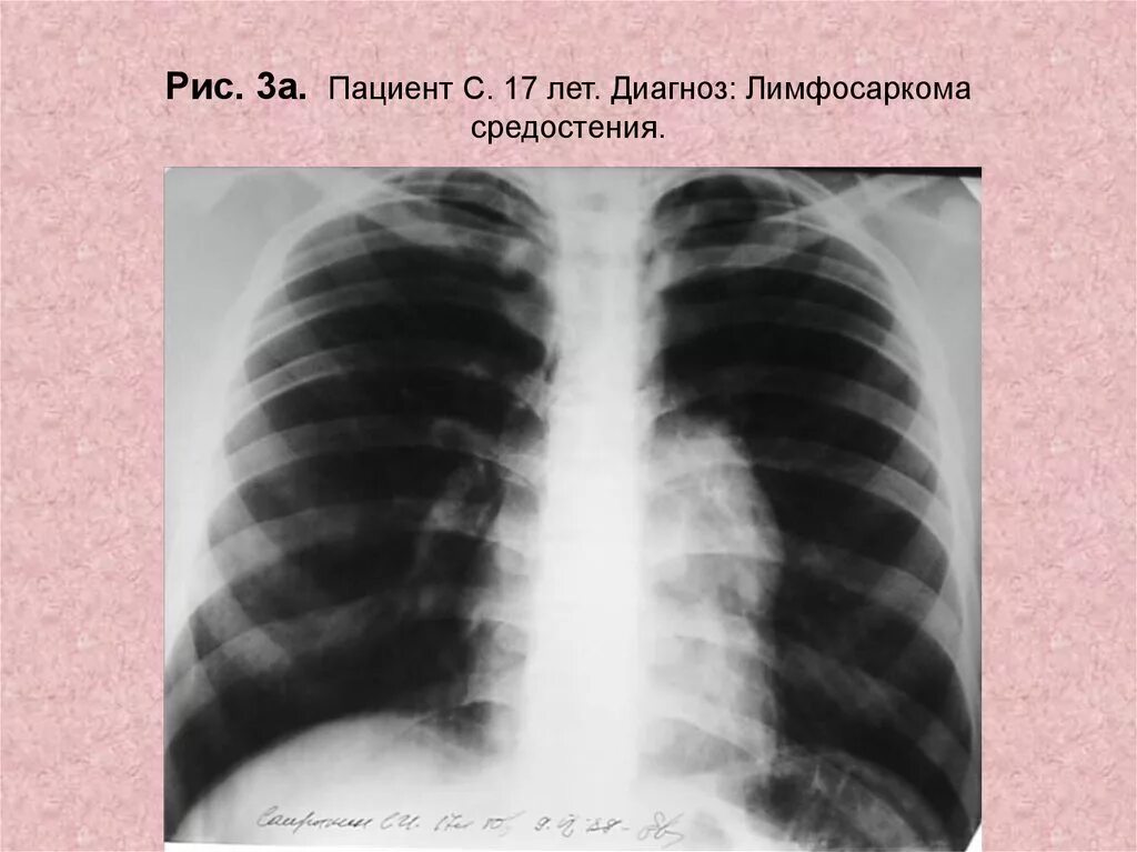 В 19 лет диагноз. А 17 диагноз. Лимфосаркома студфайл.