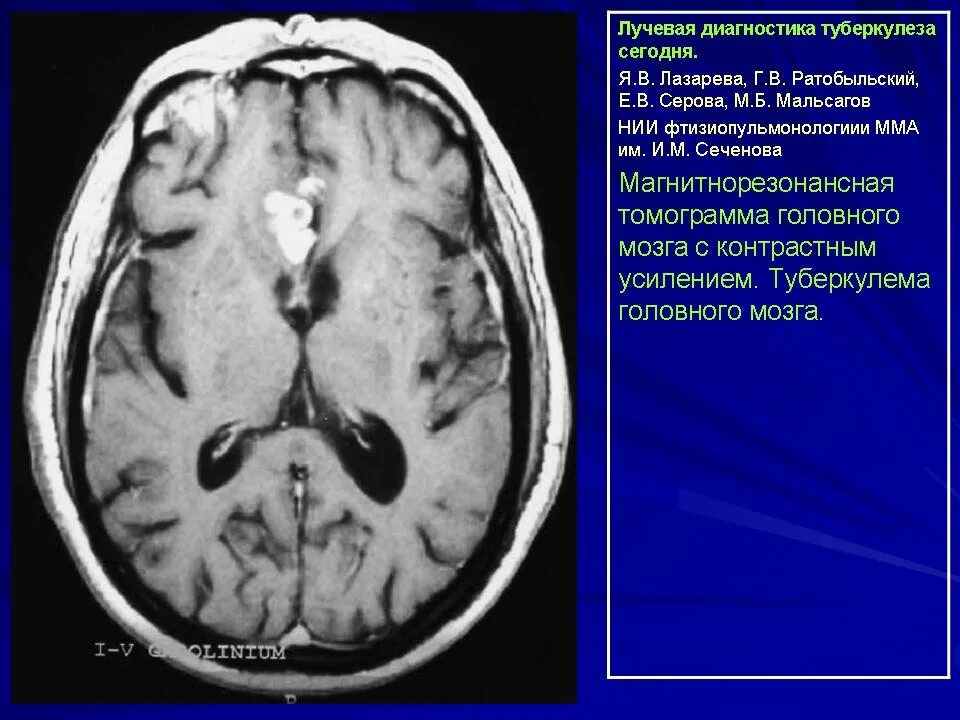 Мозговой туберкулез. Туберкулома головного мозга компьютерная томография. Туберкулез головного мозга кт. Туберкулез мозговых оболочек кт.