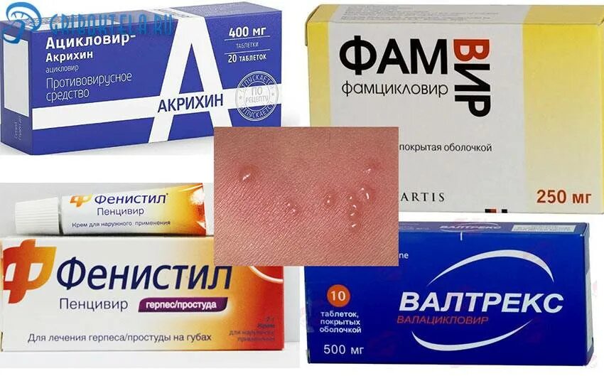 Опоясывающий герпес лечение у взрослых мазь. Препараты от герпеса на теле. лекарство от опоясывающего герпеса. таблетки от опоясывающего герпеса. препараты от опоясывающего лишая таблетками.