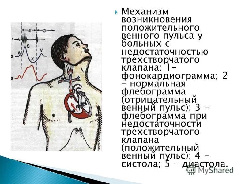 положительный венный пульс. отрицательный венный пульс. отрицательный венный пульс. отрицательный венозный пульс. положительный венный пульс характерен для.