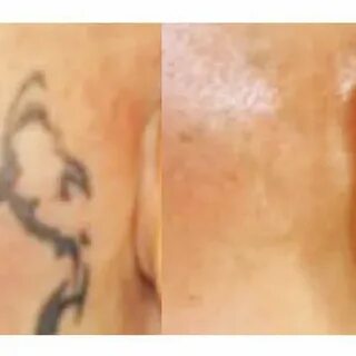 Picosure отзывы удаление