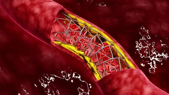 Как выглядят сосуды фото Coronavirus: COVID-19 uses spikes to damage blood vessels study finds, sparking