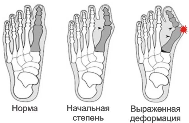 Степени вальгусной деформации. Hallux valgus схема. степени деформации халюс вальгус. вальгусная деформация большого пальца стадии. хальгус вальгус стоп степени.