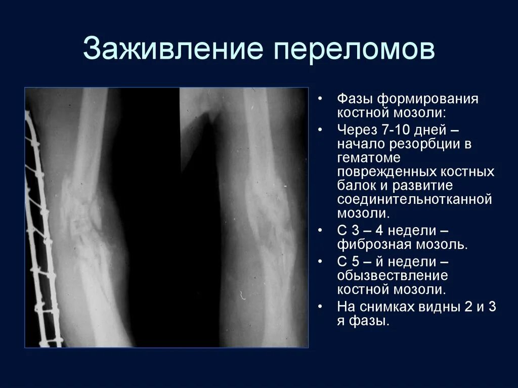 Трещина зажила. Стадии костной мозоли на рентгене. Периостальная костная мозоль рентген. Костная мозоль лучевая кость. Рентген стадии заживления переломов.