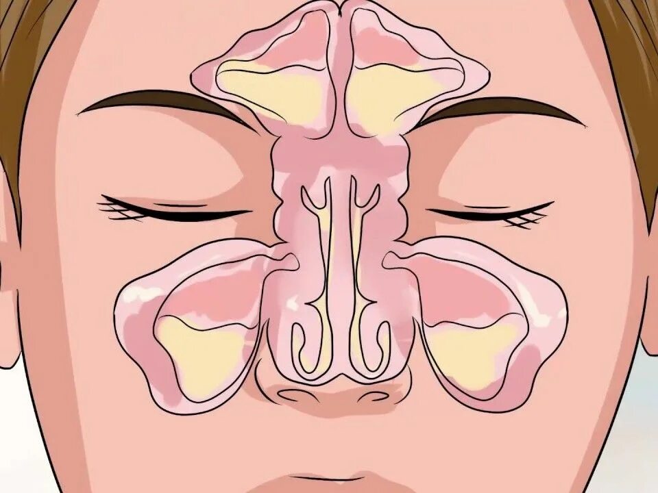 Слизь в организме причины. Где в НОСН скапливается сопли. Воспаление носовых пазух. Заложенность в переносице.