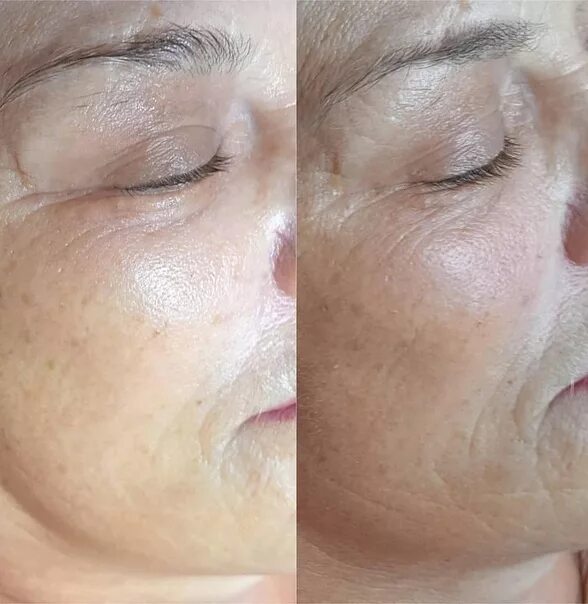 Шлифовка лица холодной плазмой. Процедура для лица холодная плазма. Холодная плазма после процедуры. Омоложение холодной плазмой. Холодное плазменное омоложение.