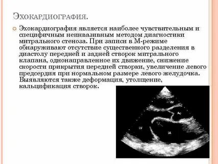 Эхокардиография сердца что это как делают подготовка