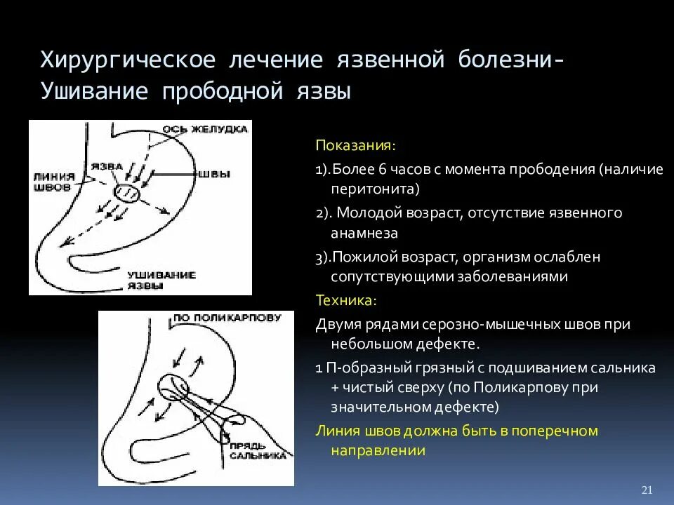 Перфоративная язва желудка ушивание. Показания к ушиванию язвы и резекции желудка. Техника ушивания прободной язвы. Хирургическое лечение перфоративной язвы желудка.