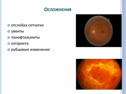 Отслойка сетчатки причины и последствия
