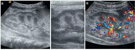 Гиперэхогенные структуры на узи печени. Корковый слой почки на узи. Гиперэхогенные пирамидки в почках на узи. Гиперэхогенная почка. Гиперэхогенная почка.