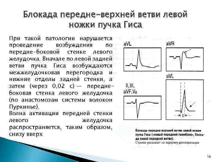 Блокада задней ножки. Блокада передне-верхней ветви ЛНПГ. Блокада передне-верхнего разветвления левой ножки пучка Гиса на ЭКГ. Блокада передневерхнего разветвления левой ножки пучка Гиса. Блокада передней ножки левой на ЭКГ.