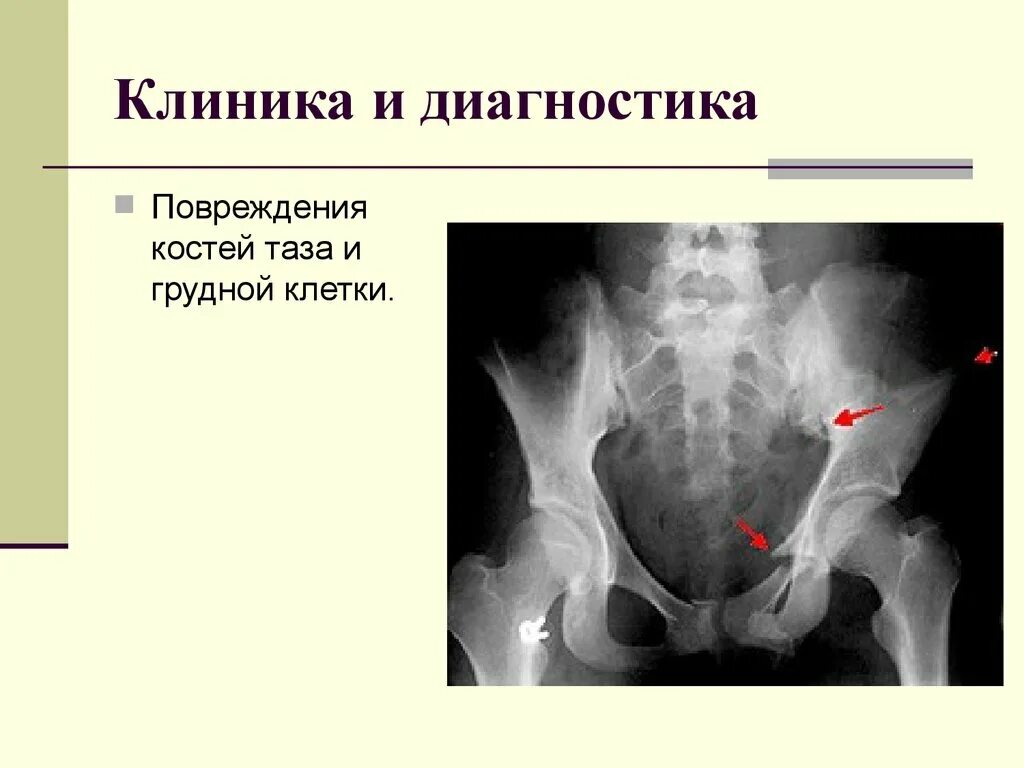 Разрыв кости. Повреждение костей таза. Диагностика костей таза. Диагностика повреждений костей таза.