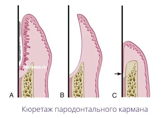 Кюретаж кармана. Кюретаж пародонтальных карманов. кюретаж пародонтальных карманов закрытый и открытый. закрытый и открытый кюретаж пародонтального кармана это. кюретаж десневых карманов.