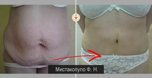 Отзыв пациентки спустя 2 дня после кольпопластики.Галина Николаевна - ведущий оп
