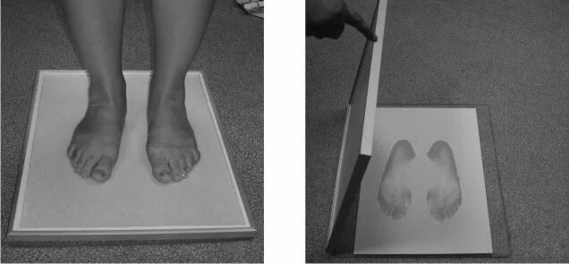 причины возникновения плоскостопия. методы исследования плоскостопия. плоскостопие врач ортопед. 60.