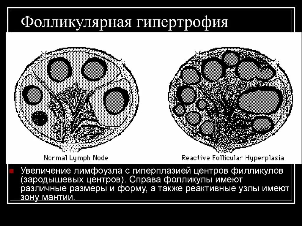 Лимфоузел реактивная гиперплазия. Фолликулярная гиперплазия лимфатического узла микропрепарат. Фолликулярная гиперплазия лимфатического узла. Лимфоузлы с реактивной гиперплазией. Реактивная гиперплазия лимфоузла