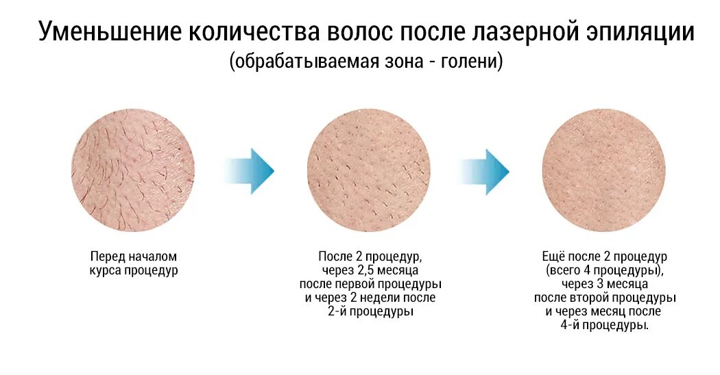 Уход после лазерной. Преимущества лазерной эпиляции. Лазер после первой процедуры. Количество процедур лазерной эпиляции. Сколько нужно процедур лазерной эпиляции.